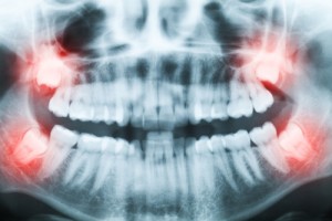 Got Impacted Wisdom Teeth Don't Rush to Extraction