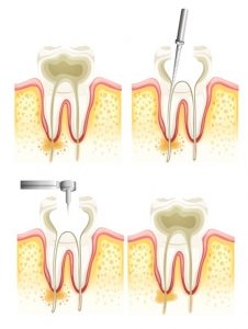Endodontist